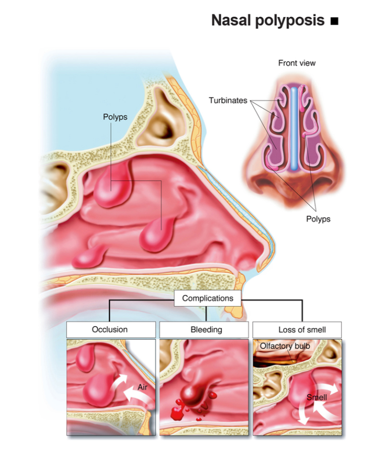 Infografis polip hidung